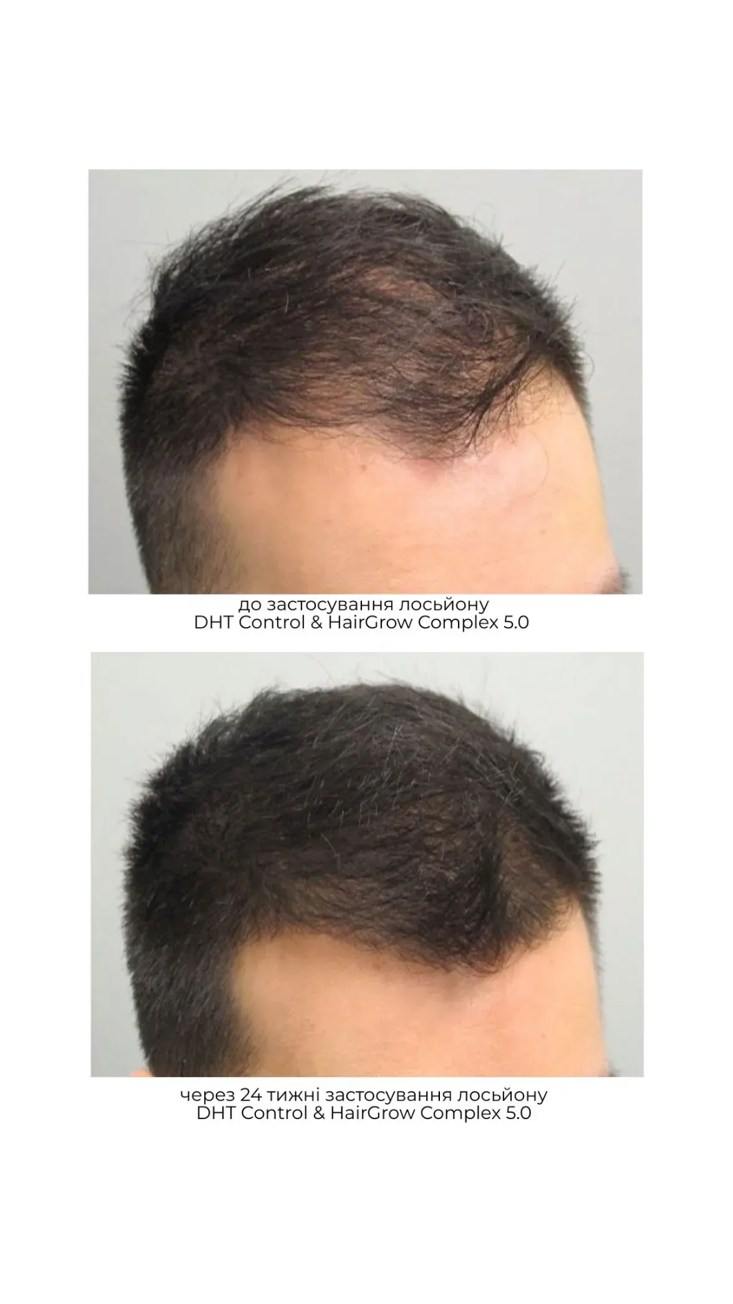 Сироватка для відновлення росту волосся DHTControl & Hairgrow Complex 5.О